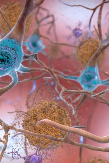 Hallmarks of Alzheimer’s found well before diagnosis