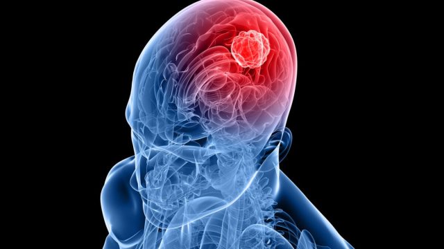 Breakthrough blood test developed for brain tumors